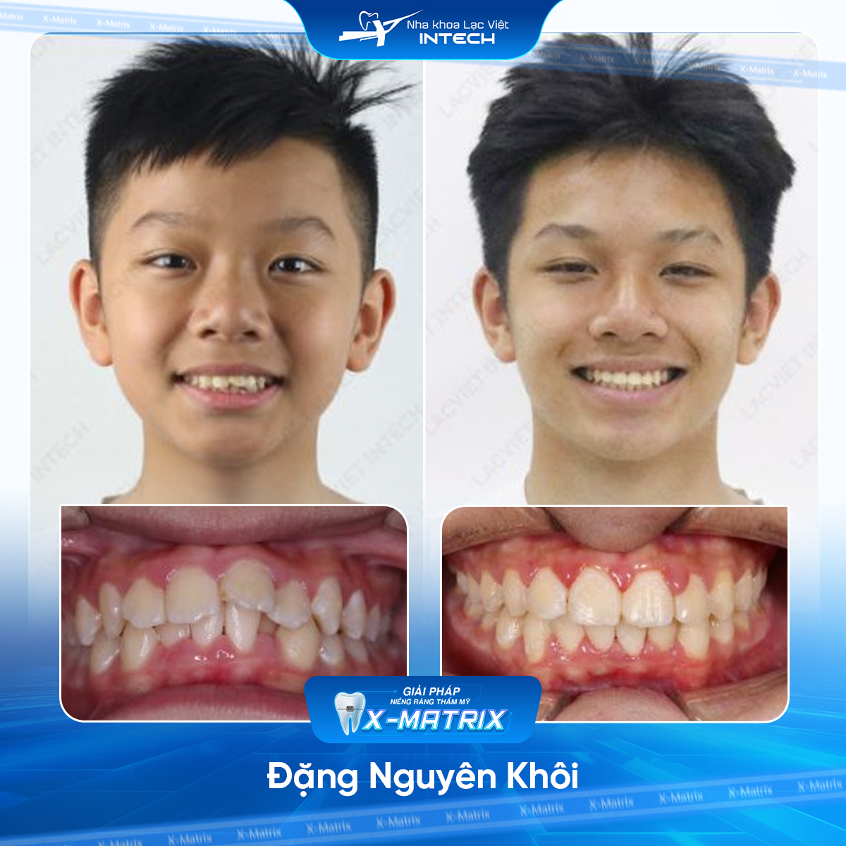 Bác sĩ niềng răng Phạm Dung | Thông Tin - Đặt Lịch Bác Sĩ 13 Bac si nieng rang Pham Dung nha khoa Lac Viet Intech