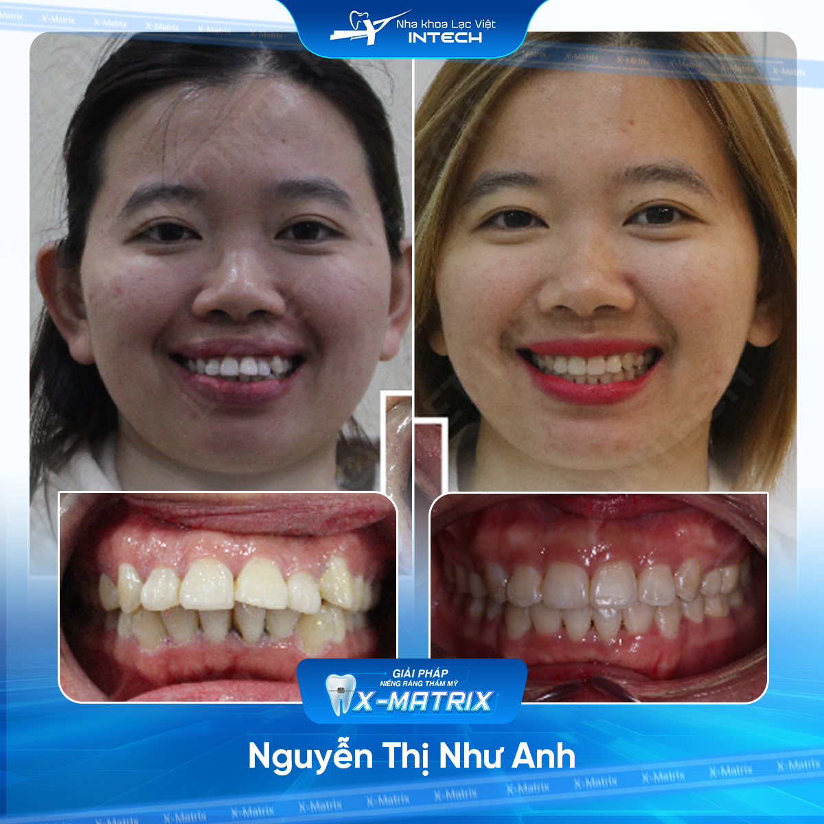 Bác sĩ niềng răng Phạm Dung | Thông Tin - Đặt Lịch Bác Sĩ 12 Bac si nieng rang Pham Dung nha khoa Lac Viet Intech