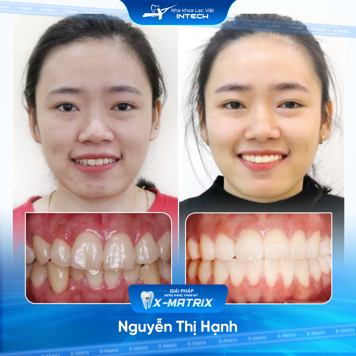 Bác sĩ niềng răng Phạm Dung | Thông Tin - Đặt Lịch Bác Sĩ 11 Bac si nieng rang Pham Dung nha khoa Lac Viet Intech