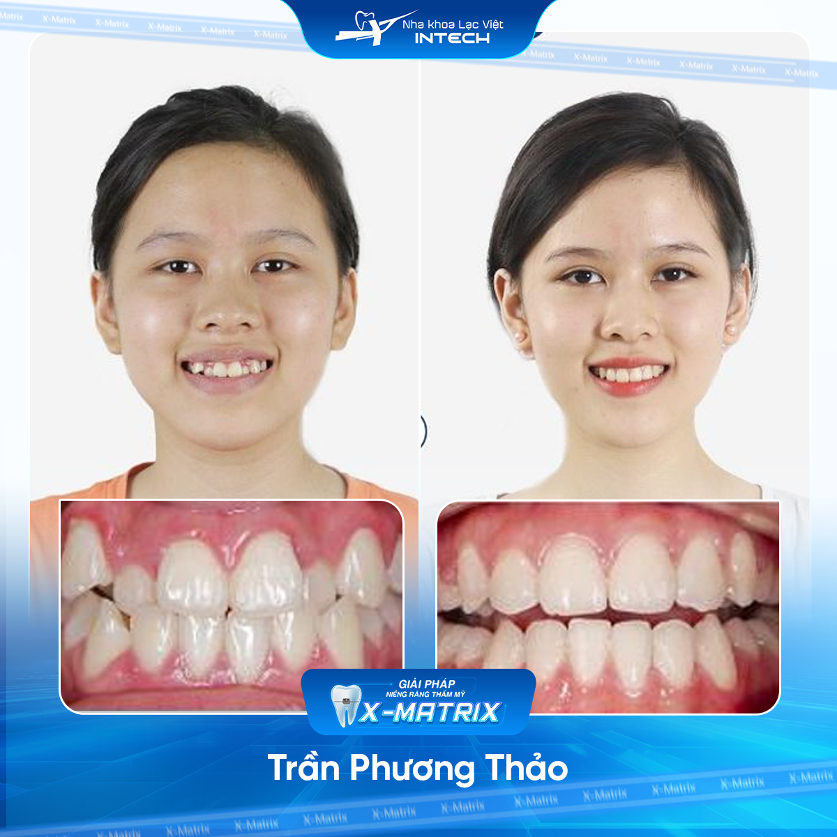 Bác sĩ niềng răng Thu Anh | Thông Tin - Đặt Lịch Bác Sĩ 17 Bac si nieng rang Thu Anh nha khoa Lac Viet Intech