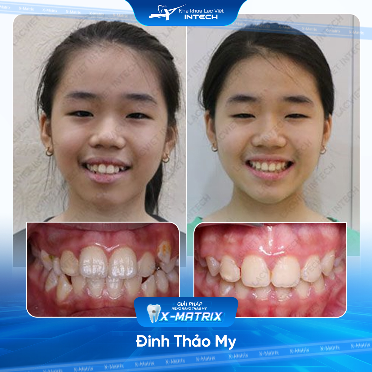 Bác sĩ niềng răng Thu Anh | Thông Tin - Đặt Lịch Bác Sĩ 10 Bac si nieng rang Thu Anh nha khoa Lac Viet Intech