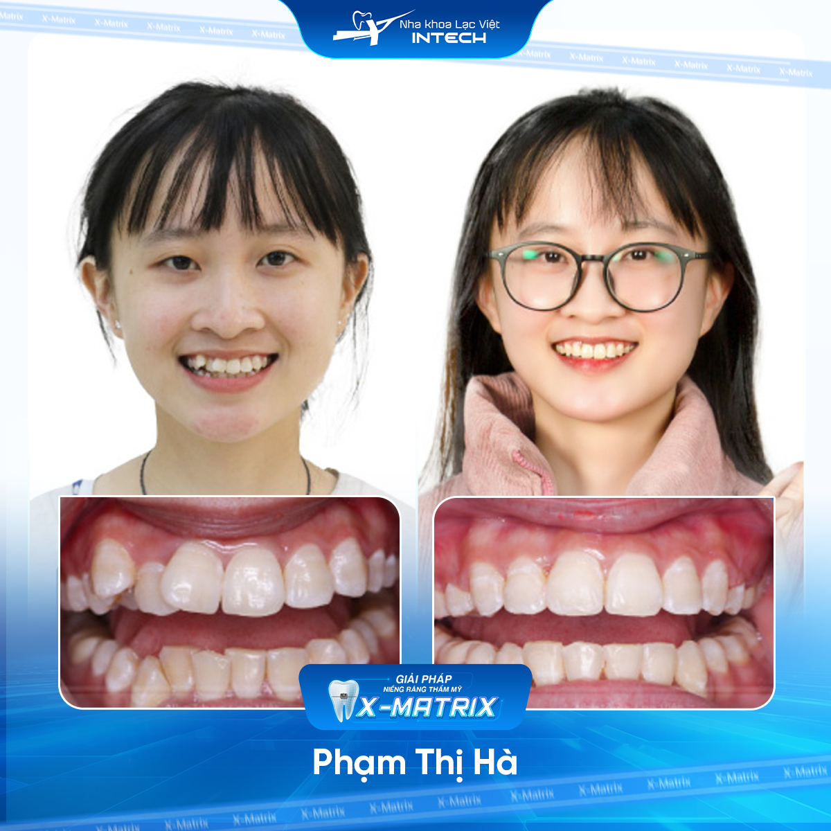 Bác sĩ niềng răng Thu Anh | Thông Tin - Đặt Lịch Bác Sĩ 9 Bac si nieng rang Thu Anh nha khoa Lac Viet Intech
