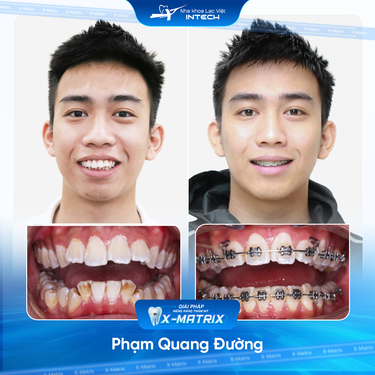 Bác sĩ niềng răng Thu Anh | Thông Tin - Đặt Lịch Bác Sĩ 18 Bac si nieng rang Thu Anh nha khoa Lac Viet Intech