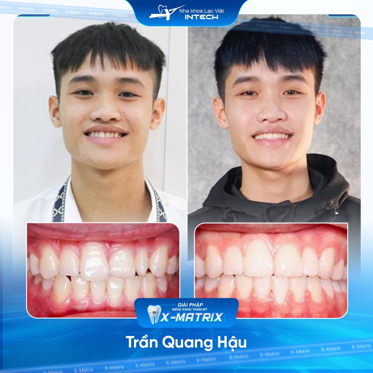 Bác sĩ niềng răng Thu Anh | Thông Tin - Đặt Lịch Bác Sĩ 16 Bac si nieng rang Thu Anh nha khoa Lac Viet Intech