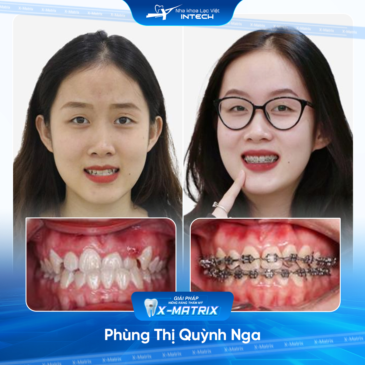 Bác sĩ niềng răng Thu Anh | Thông Tin - Đặt Lịch Bác Sĩ 15 Bac si nieng rang Thu Anh nha khoa Lac Viet Intech