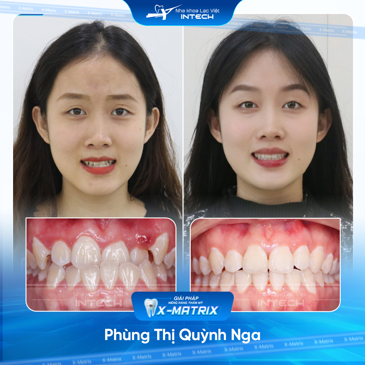 Bác sĩ niềng răng Thu Anh | Thông Tin - Đặt Lịch Bác Sĩ 14 Bac si nieng rang Thu Anh nha khoa Lac Viet Intech