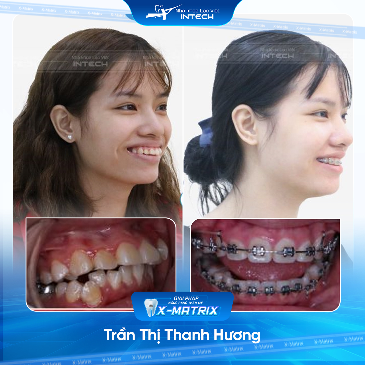 Bác sĩ niềng răng Thu Anh | Thông Tin - Đặt Lịch Bác Sĩ 12 Bac si nieng rang Thu Anh nha khoa Lac Viet Intech