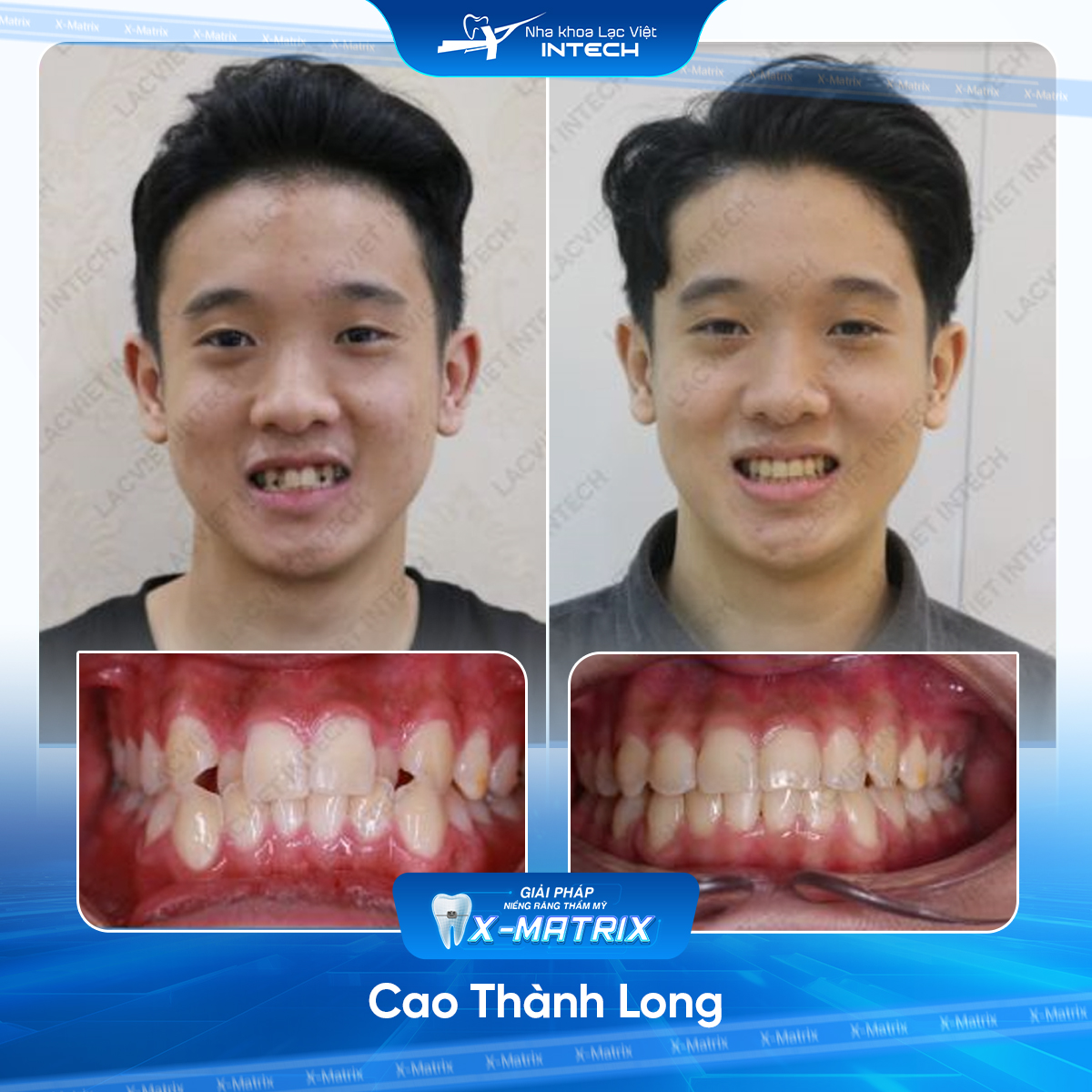 Bác sĩ niềng răng Thu Anh | Thông Tin - Đặt Lịch Bác Sĩ 11 Bac si nieng rang Thu Anh nha khoa Lac Viet Intech