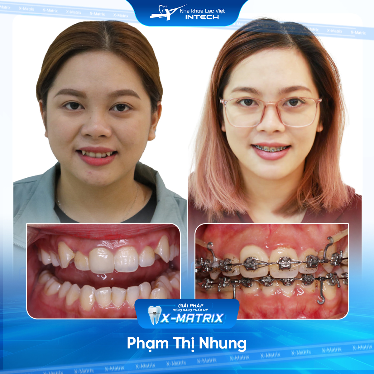 Bác sĩ niềng răng Ngọc Ánh | Thông Tin - Đặt Lịch Bác Sĩ 8 Bac si nieng rang Ngoc Anh nha khoa Lac Viet Intech