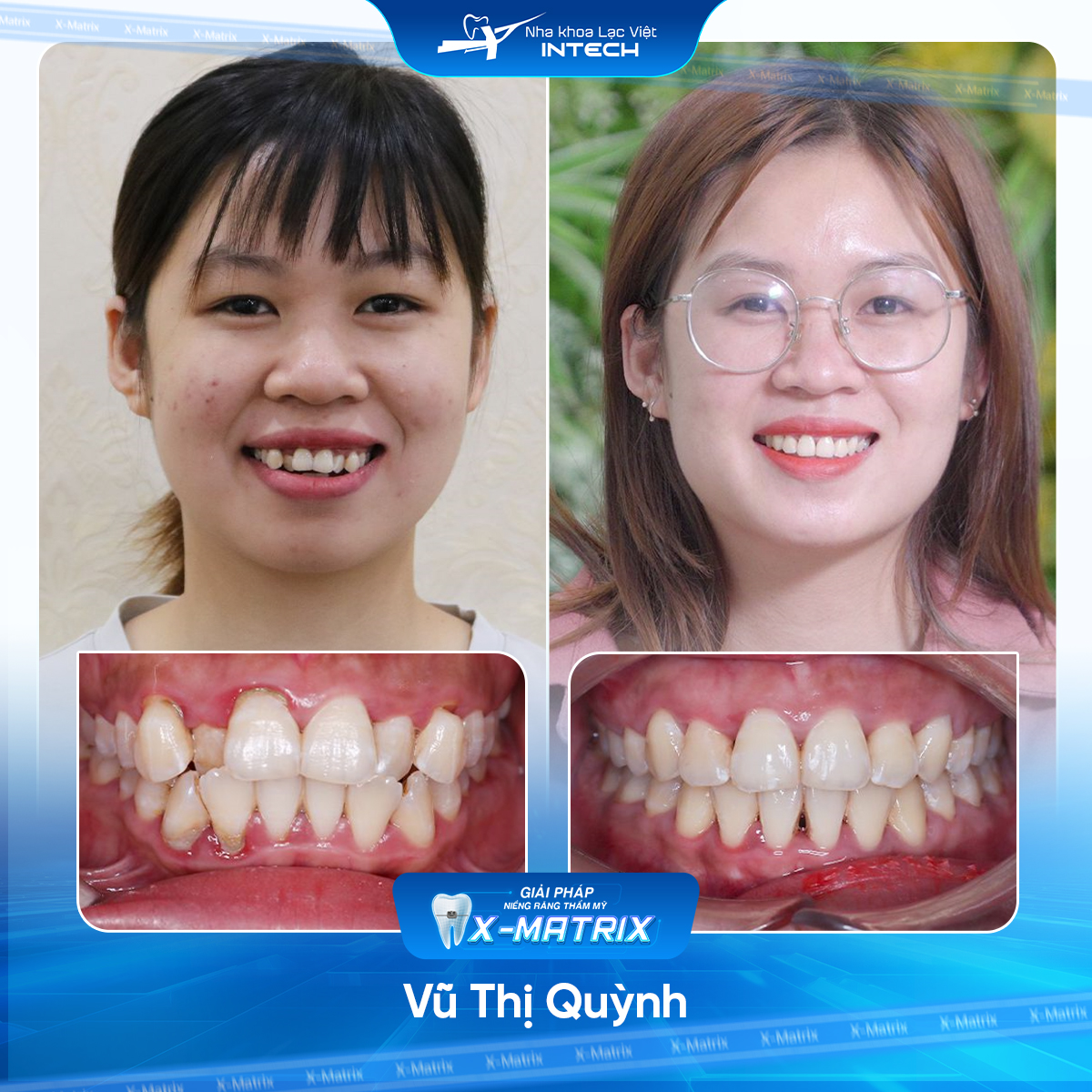 Bác sĩ niềng răng Ngọc Ánh | Thông Tin - Đặt Lịch Bác Sĩ 16 Bac si nieng rang Ngoc Anh nha khoa Lac Viet Intech