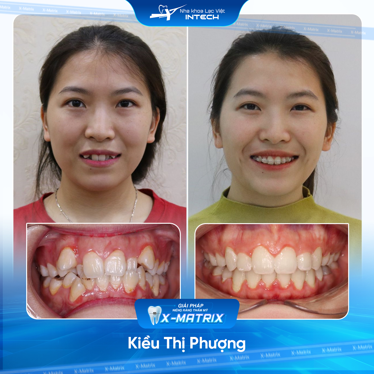 Bác sĩ niềng răng Ngọc Ánh | Thông Tin - Đặt Lịch Bác Sĩ 17 Bac si nieng rang Ngoc Anh nha khoa Lac Viet Intech