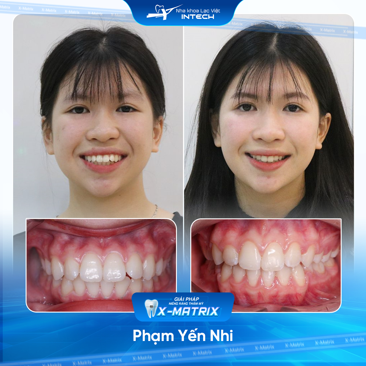 Bác sĩ niềng răng Ngọc Ánh | Thông Tin - Đặt Lịch Bác Sĩ 9 Bac si nieng rang Ngoc Anh nha khoa Lac Viet Intech