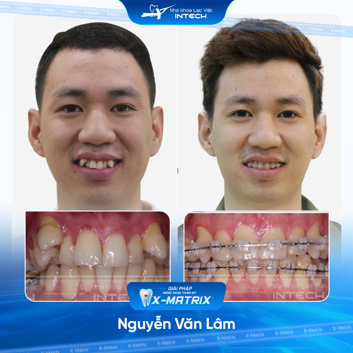 Bác sĩ niềng răng Ngọc Ánh | Thông Tin - Đặt Lịch Bác Sĩ 10 Bac si nieng rang Ngoc Anh nha khoa Lac Viet Intech