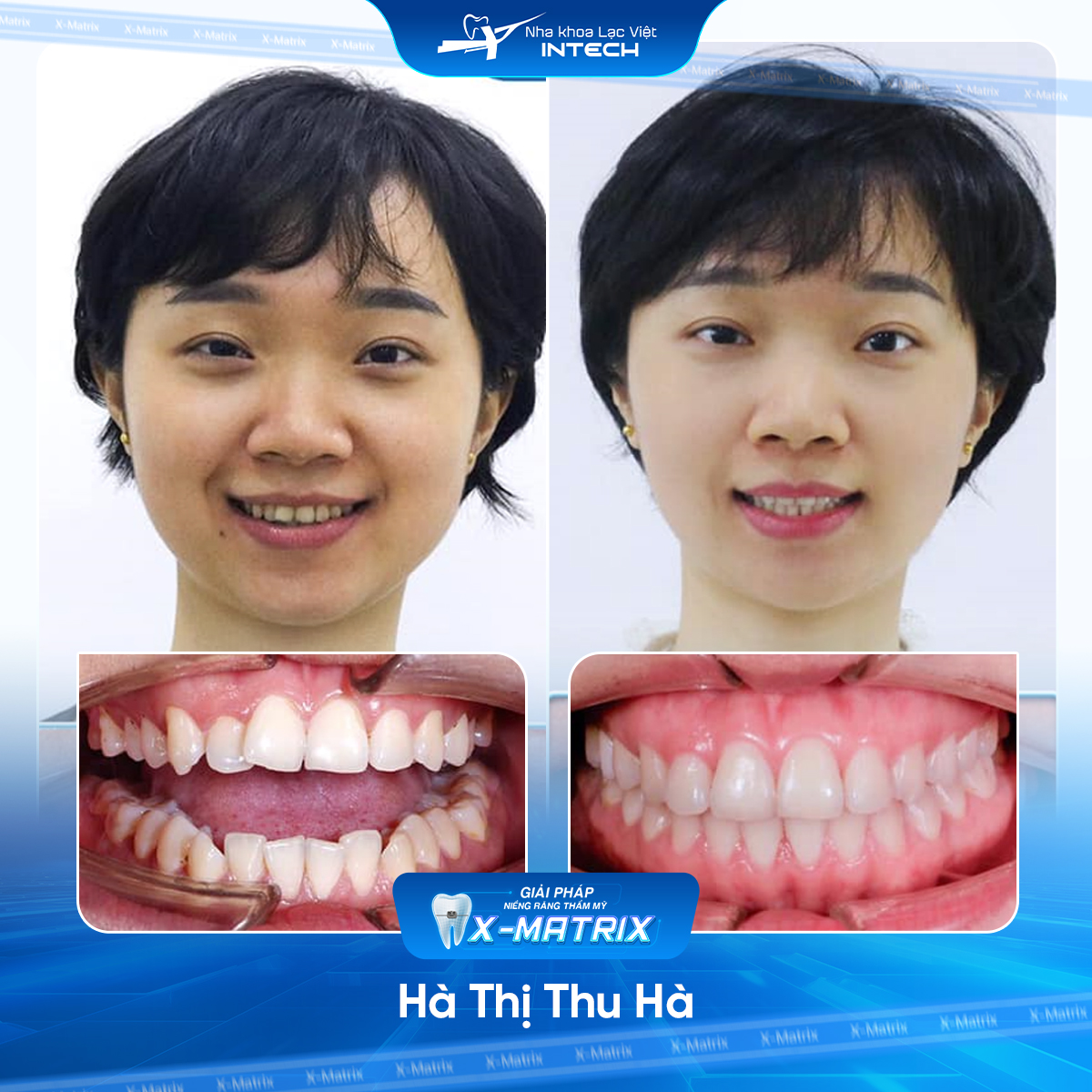 Bác sĩ niềng răng Ngọc Ánh | Thông Tin - Đặt Lịch Bác Sĩ 11 Bac si nieng rang Ngoc Anh nha khoa Lac Viet Intech