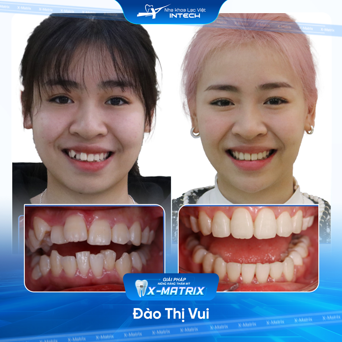 Bác sĩ niềng răng Ngọc Ánh | Thông Tin - Đặt Lịch Bác Sĩ 12 Bac si nieng rang Ngoc Anh nha khoa Lac Viet Intech