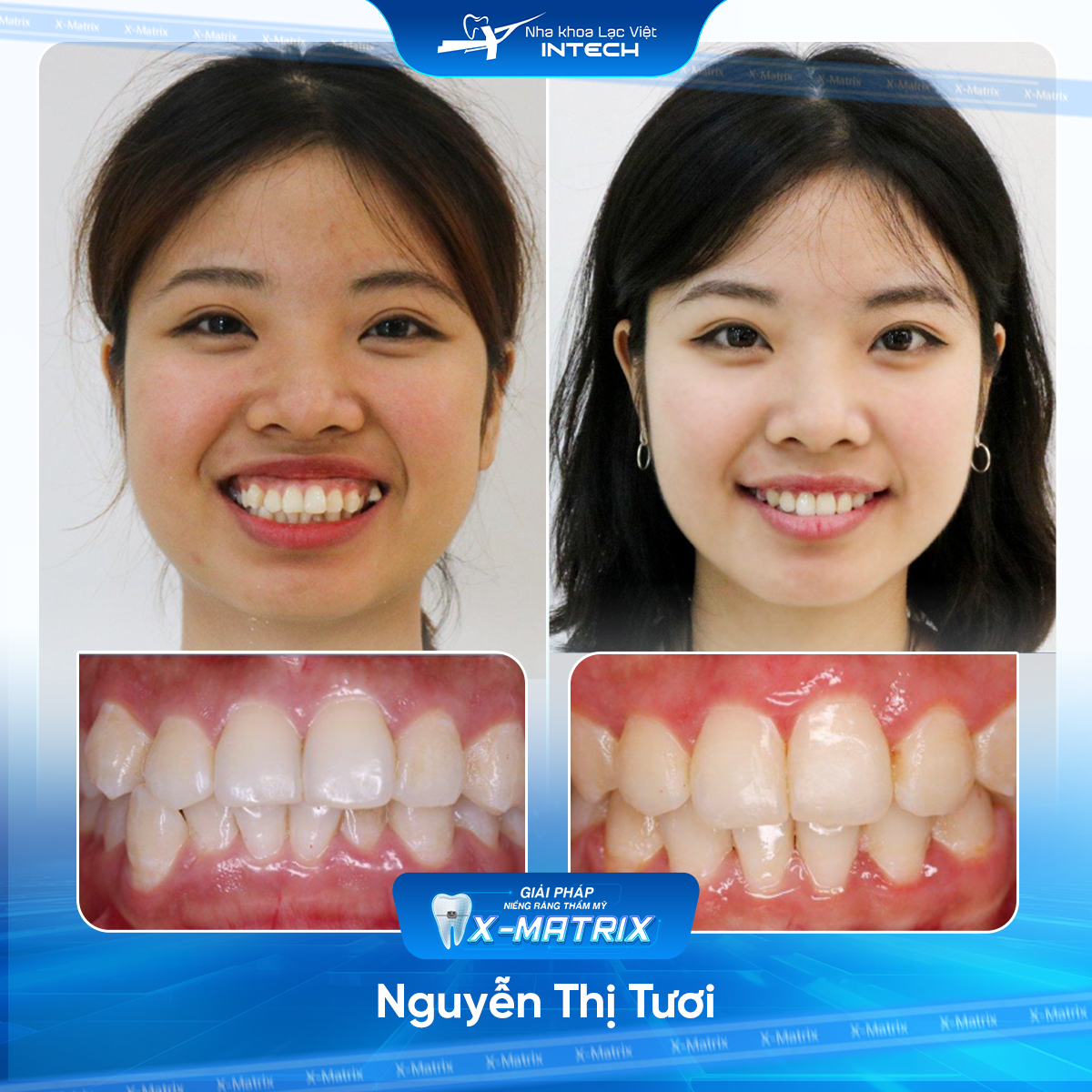 Bác sĩ niềng răng Ngọc Ánh | Thông Tin - Đặt Lịch Bác Sĩ 13 Bac si nieng rang Ngoc Anh nha khoa Lac Viet Intech