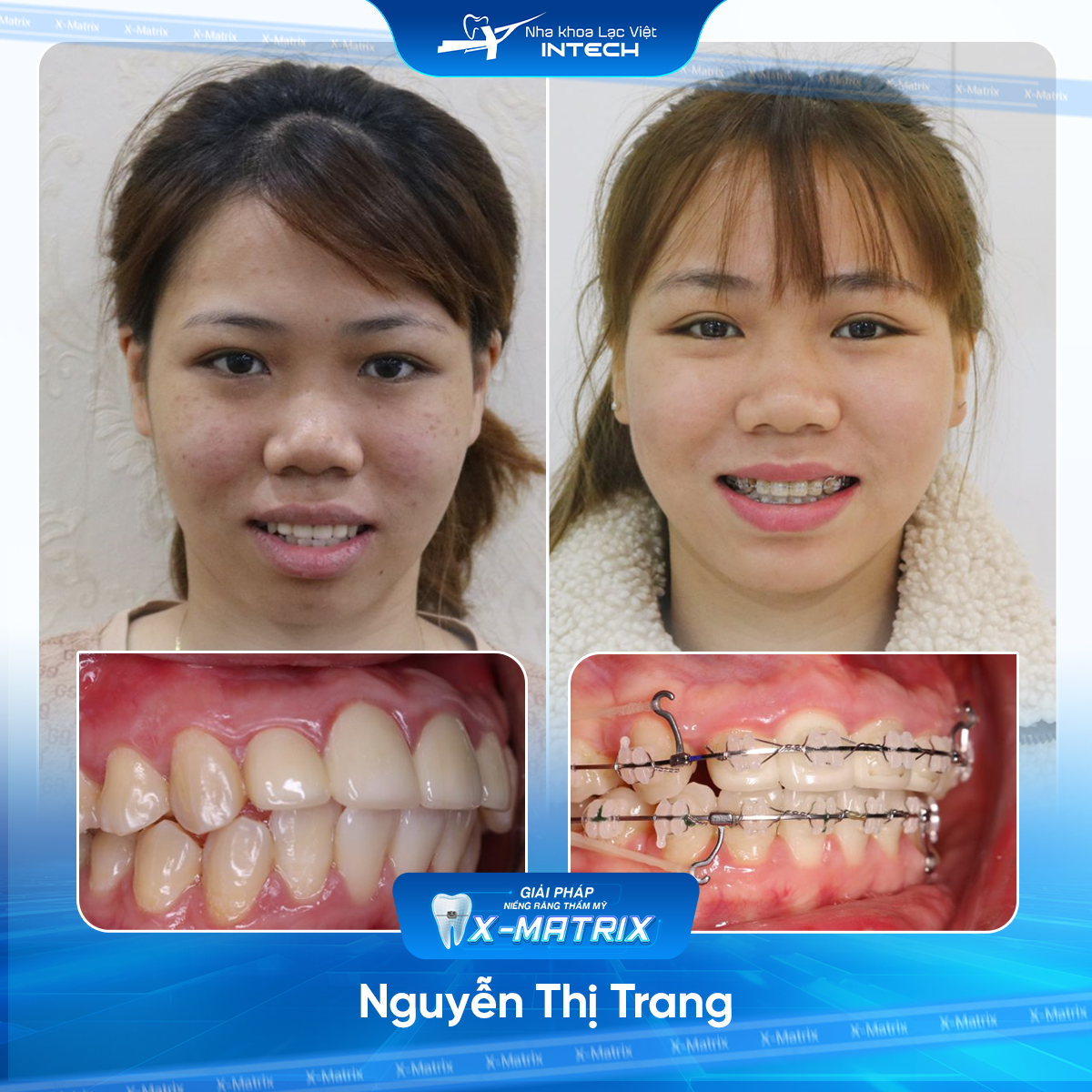 Bác sĩ niềng răng Ngọc Ánh | Thông Tin - Đặt Lịch Bác Sĩ 14 Bac si nieng rang Ngoc Anh nha khoa Lac Viet Intech