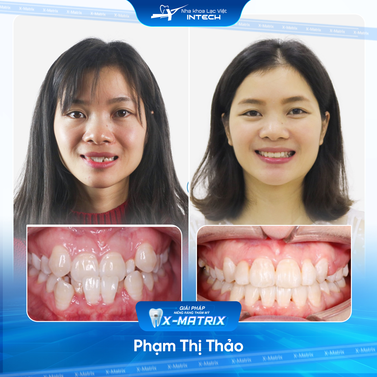Bác sĩ niềng răng Ngọc Ánh | Thông Tin - Đặt Lịch Bác Sĩ 15 Bac si nieng rang Ngoc Anh nha khoa Lac Viet Intech