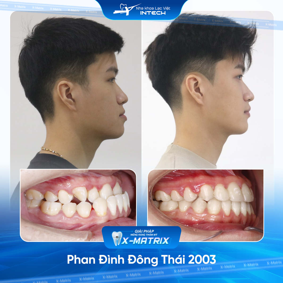 Kết quả niềng răng tại Đống Đa – Lạc Việt Intech