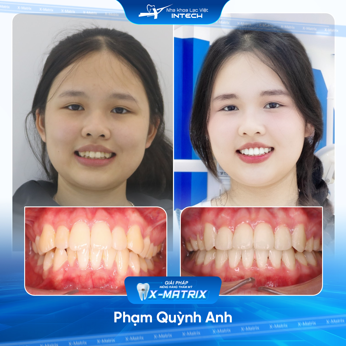 Kết quả niềng răng tại Đống Đa – Lạc Việt Intech
