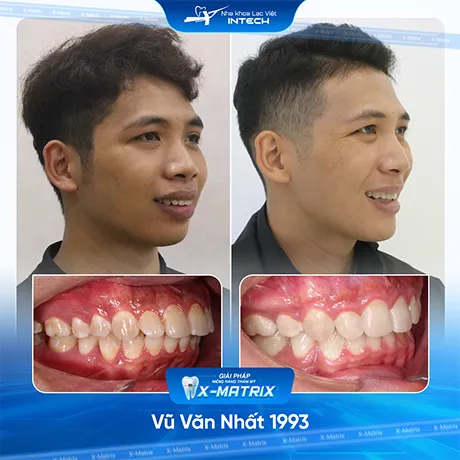 Hinh anh khach hang nieng rang nha khoa lac viet intech (1)