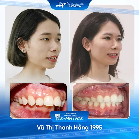 Hinh anh khach hang nieng rang nha khoa lac viet intech (2)