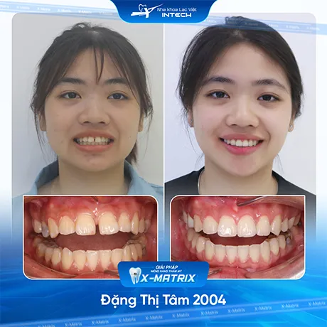 Hinh anh khach hang nieng rang nha khoa lac viet intech (3)