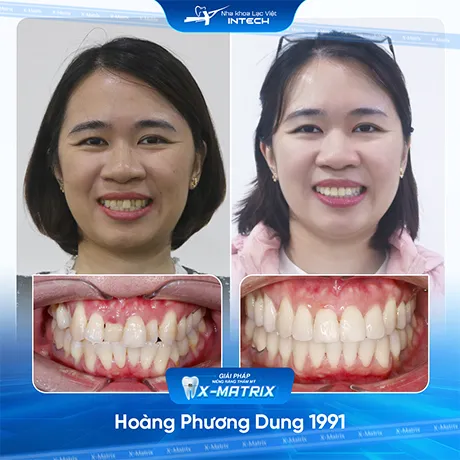 Hinh anh khach hang nieng rang nha khoa lac viet intech (4)