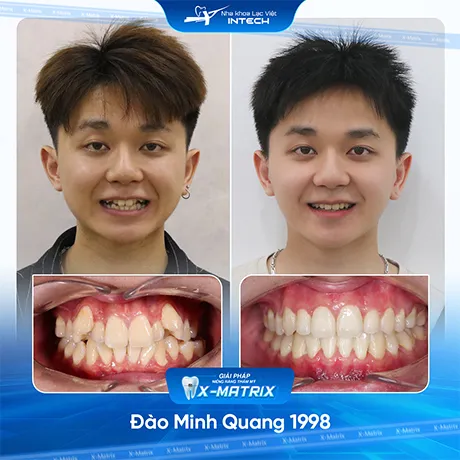 Hinh anh khach hang nieng rang nha khoa lac viet intech (5)