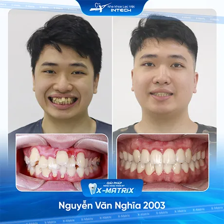 Hinh anh khach hang nieng rang nha khoa lac viet intech (6)